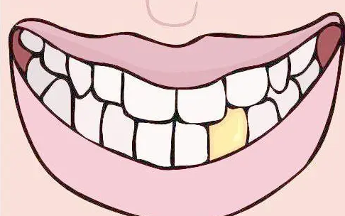 牙贴多久贴一次？牙齿贴片的优缺点有哪些？